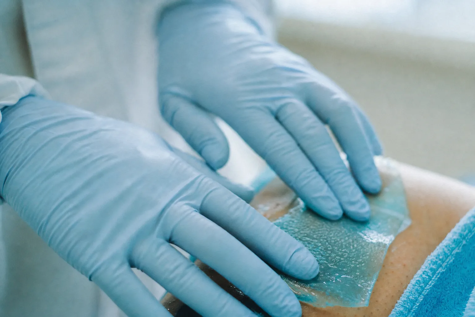 Praticien ganté appliquant une membrane gel de protection sur la peau avant la pose de l'applicateur de cryolipolyse