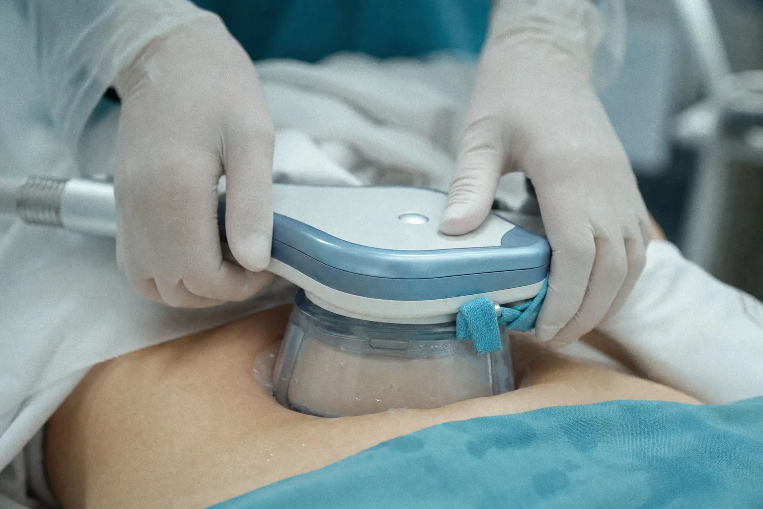 Applicateur de cryolipolyse posé sur le ventre par un praticien ganté en cabinet